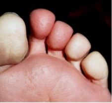 Foot with Raynaud's syndrome