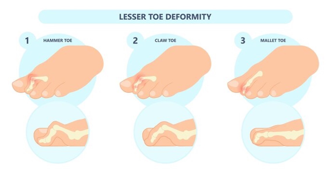 lesser toe deformity