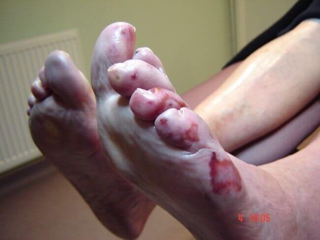foot with raynauds syndrome