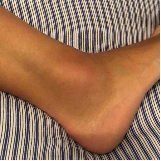 swollen ankle bruising