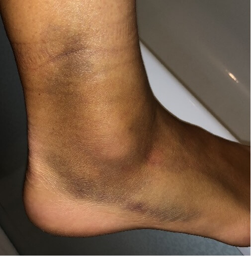 swollen ankle bruising