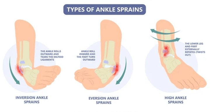 types of ankle sprains