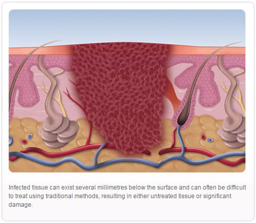 how swift microwave treatment works