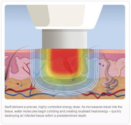 swift microwave treatment destroying infected tissue